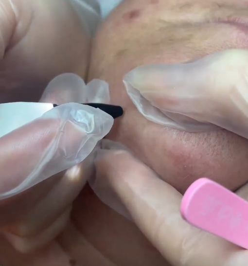 Electrolysis at The Skin Method