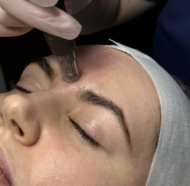 Skin Needling at The Skin Method