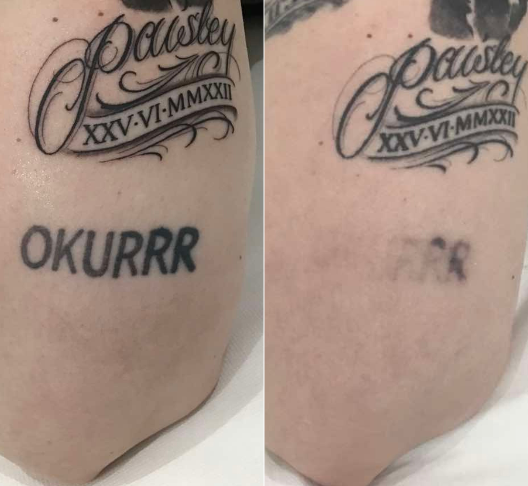 Tattoo removal at The Skin Method